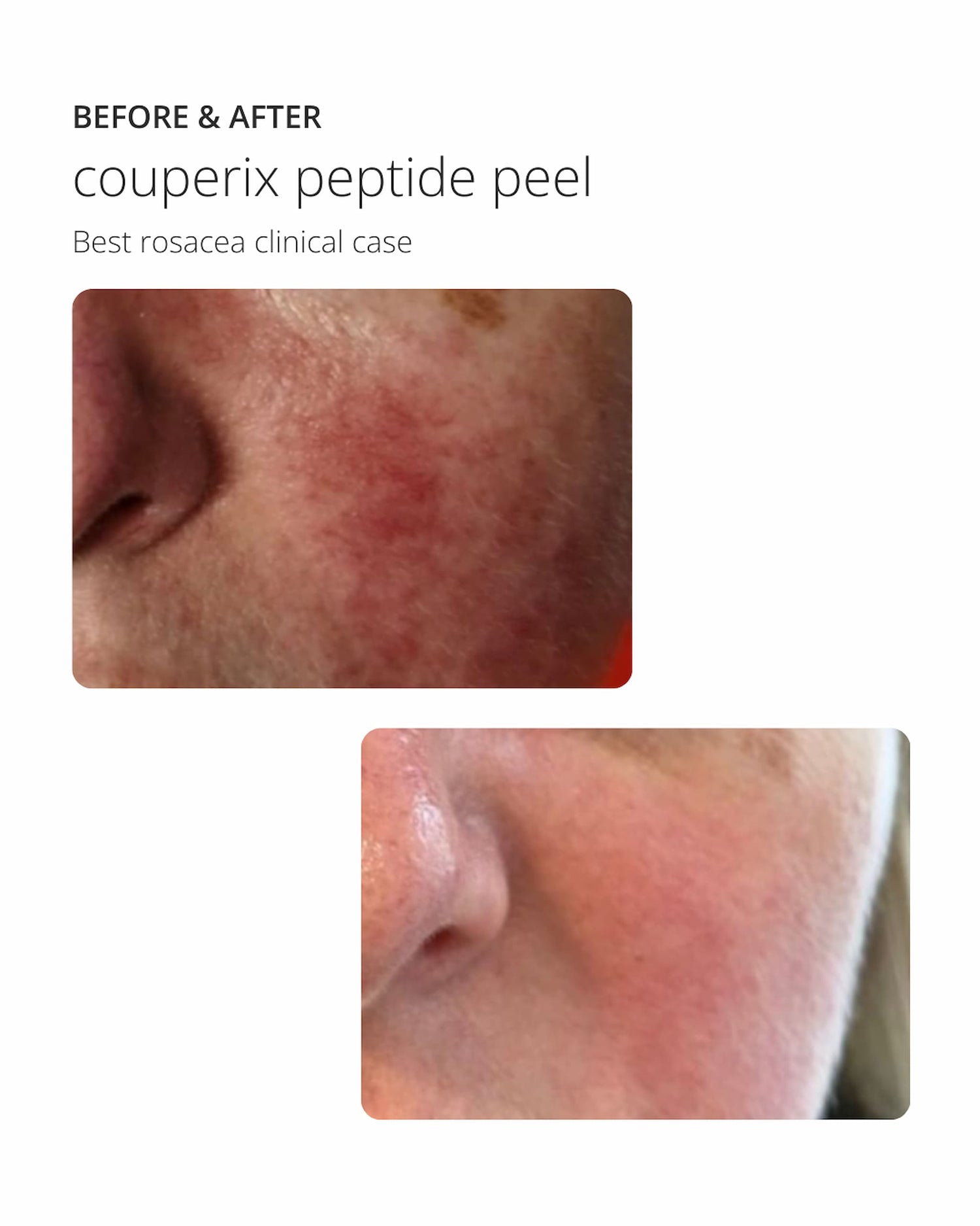 Peeling aux peptides Couperix, Peeling superficiel pour le traitement de la couperose et des rougeurs cutanées ekseption 70ml