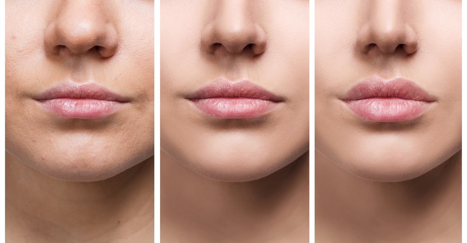 F-Perfect Lips principes actifs ultra-purs en flacons stériles pour des lèvres définies, volumineuses et plus colorées Fusion Meso 5 x 5ml